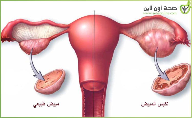 الزنجبيل ومشكلتي مع التكيس