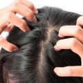 هل تريد التخلص منها- 9 طرق لعلاج قشرة الشعر فعّالة وقوية - تعرف عليها