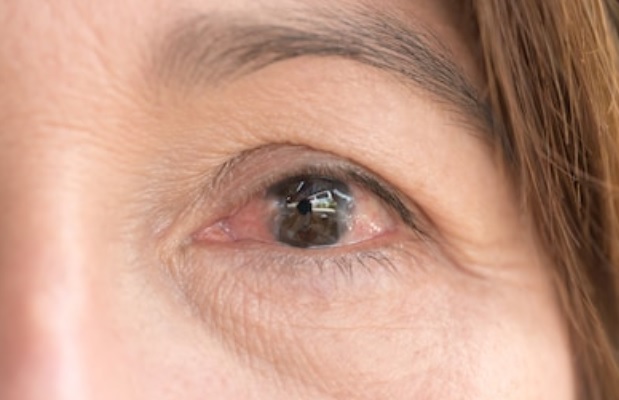 ما هو ظفرة العين - | عملية ظفرة العين | افضل مستشفى لعلاج العيون في ايران |  طب توب